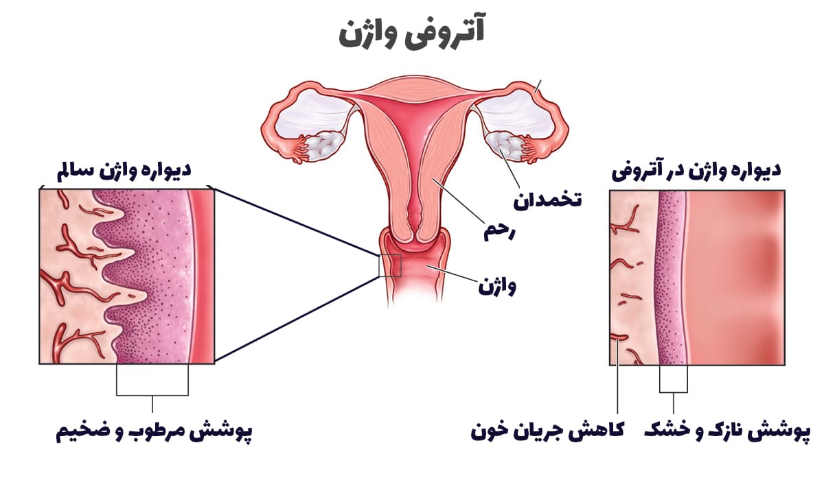 علائم آتروفی واژن