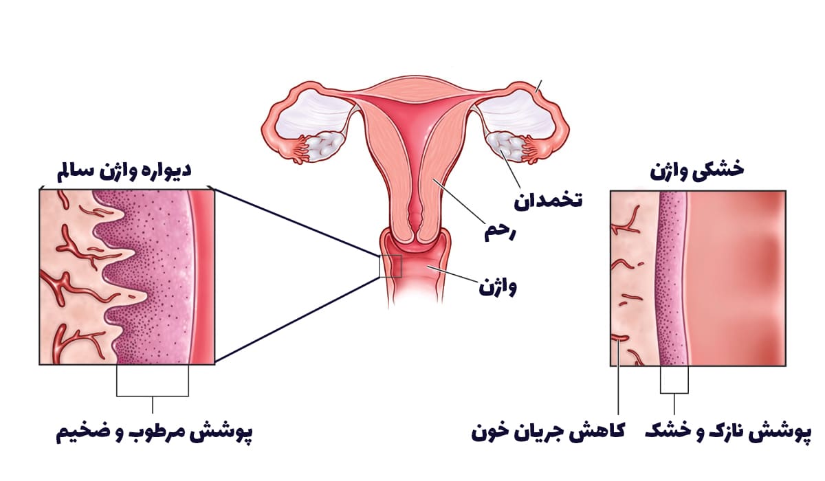 علائم خشکی واژن با عکس