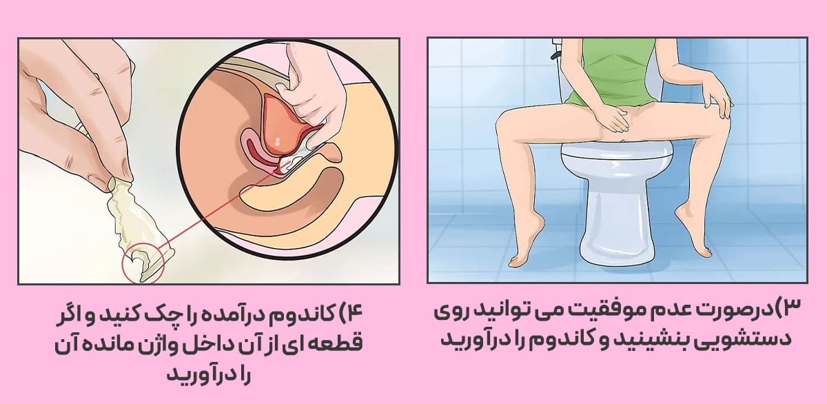 خارج کردن کاندوم از واژن