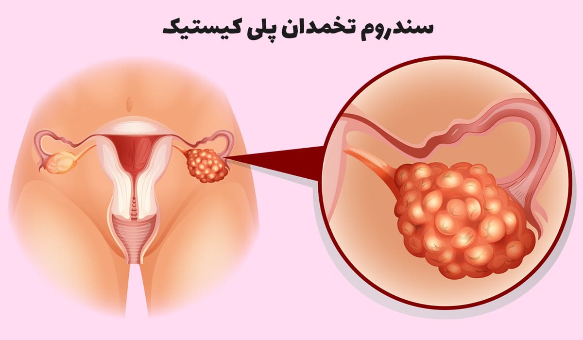 درد تخمدان به علت کیست تخمدان