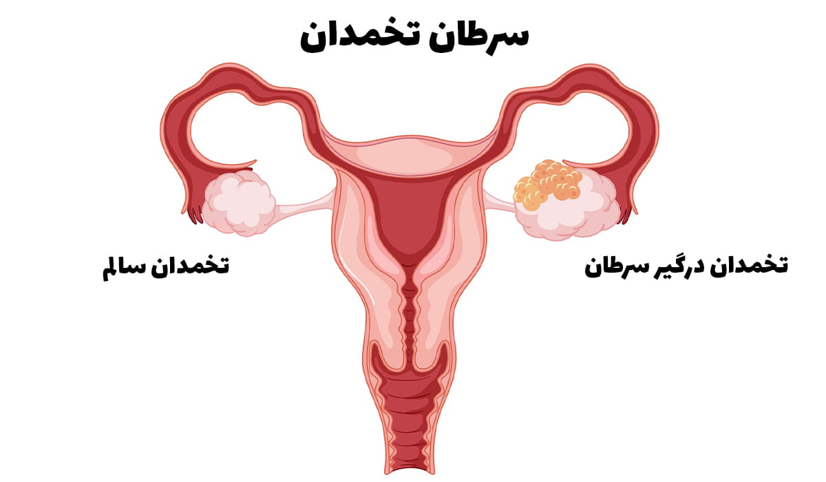 درد تخمدان به علت سرطان تخمدان