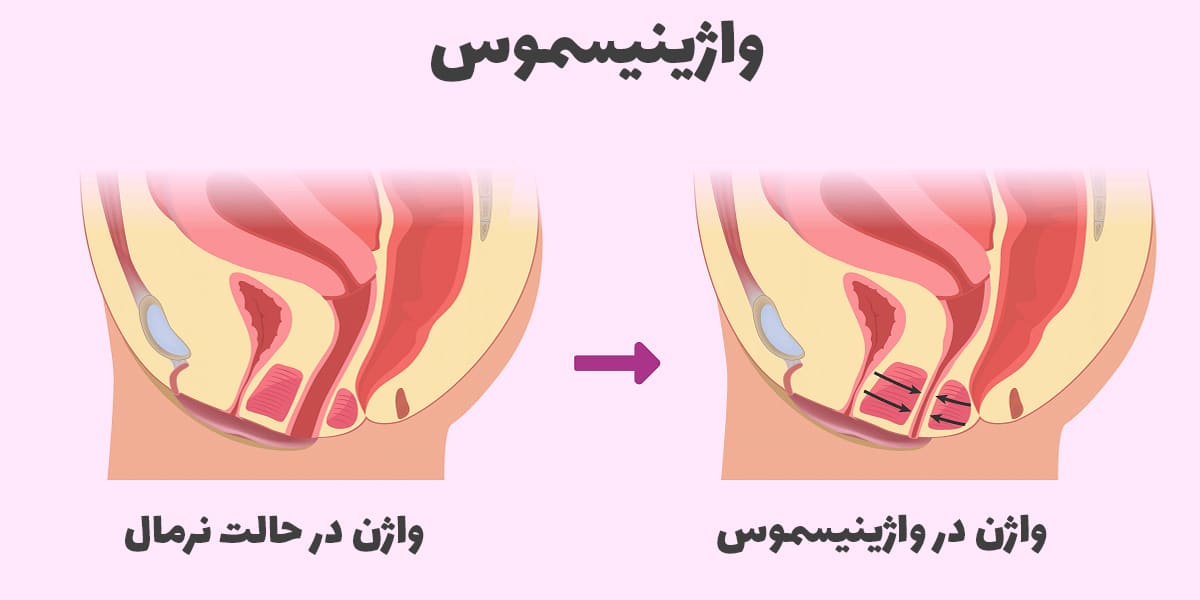 علائم واژینیسموس